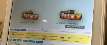 30代男がインビザライン歯列矯正を毎週更新するブログ記事。｜ついにアライナー生活を２年半、継続達成！